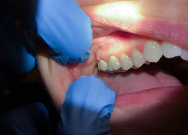 Best Emergency Dentist for Knocked-Out Tooth in Pleasant Valley, WV